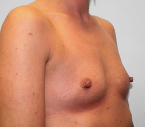 Before Image: Breast Augmentation – Dr. Howell - right-front-oblique