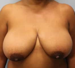 Before Image: Breast Reduction – Dr. Howell - front