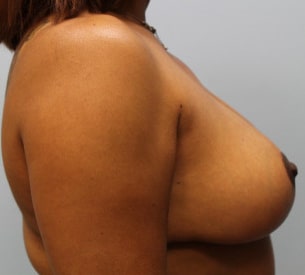 After Image: Breast Reduction – Dr. Howell - right-side