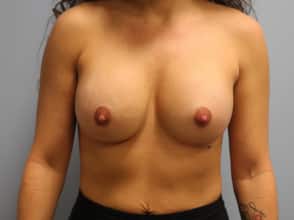 After Image: Breast Augmentation Revision – Dr. Tucker - front