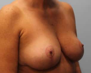 After Image: Breast Reduction – Dr. Howell - right-front-oblique