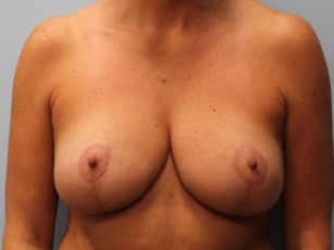 After Image: Breast Reduction – Dr. Howell - front