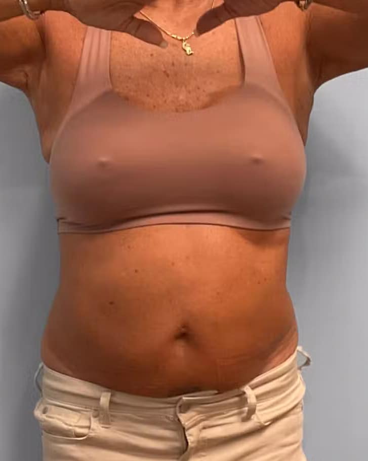 Before Image: Emsculpt Neo – Jessica - front