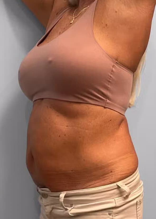 Before Image: Emsculpt Neo – Jessica - left-side