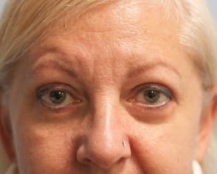 After Image: Upper and Lower Blepharoplasty-Dr.Howell - front