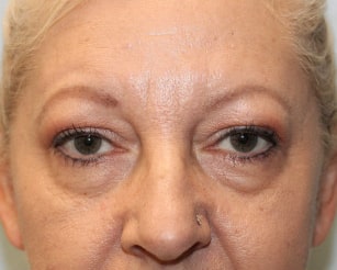 Before Image: Upper and Lower Blepharoplasty-Dr.Howell - front