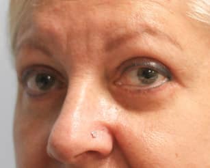 After Image: Upper and Lower Blepharoplasty-Dr.Howell - left-front-oblique
