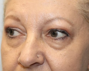 Before Image: Upper and Lower Blepharoplasty-Dr.Howell - left-front-oblique