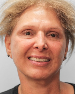 After Image: Facelift and Neck Lipo-Dr.Howell - front