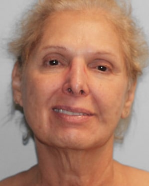 Before Image: Facelift and Neck Lipo-Dr.Howell - front