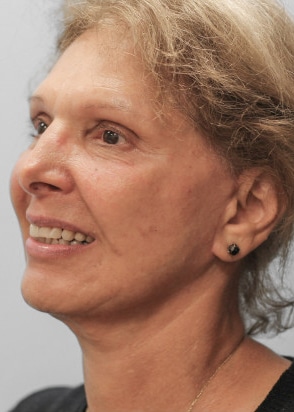 After Image: Facelift and Neck Lipo-Dr.Howell - left-front-oblique