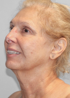 Before Image: Facelift and Neck Lipo-Dr.Howell - left-front-oblique