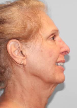Before Image: Facelift and Neck Lipo-Dr.Howell - right-side