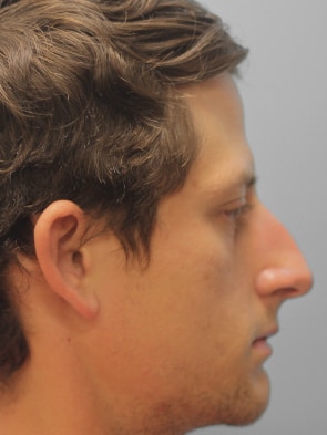 Before Image: Rhinoplasty-Dr.Tucker - right-side