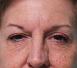 After Image: Upper Blepharoplasty-Dr.Tucker - front