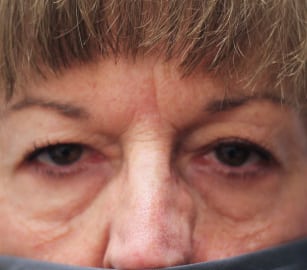 Before Image: Upper Blepharoplasty-Dr.Tucker - front