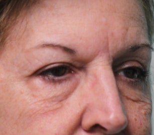 After Image: Upper Blepharoplasty-Dr.Tucker - right-front-oblique