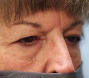 Before Image: Upper Blepharoplasty-Dr.Tucker - right-front-oblique