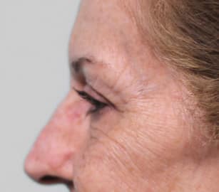 After Image: Upper Blepharoplasty-Dr.Tucker - left-side