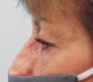Before Image: Upper Blepharoplasty-Dr.Tucker - left-side