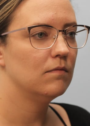 After Image: Kybella- Dr.Howell - right-front-oblique
