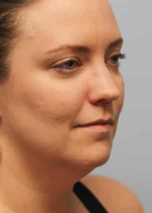 Before Image: Kybella- Dr.Howell - right-front-oblique