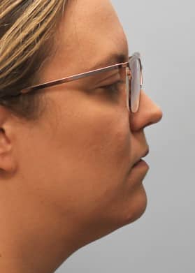 After Image: Kybella- Dr.Howell - right-side