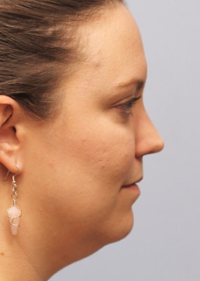 Before Image: Kybella- Dr.Howell - right-side