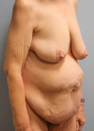Before Image: Abdominoplasty, Lipo, and Arm Lift-Dr.Tucker - right-front-oblique