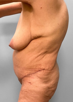 After Image: Abdominoplasty, Lipo, and Arm Lift-Dr.Tucker - left-side