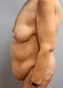 Before Image: Abdominoplasty, Lipo, and Arm Lift-Dr.Tucker - left-side