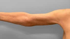 After Image: Abdominoplasty, Lipo, and Arm Lift-Dr.Tucker - right-side