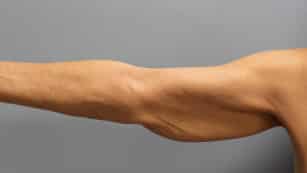 Before Image: Abdominoplasty, Lipo, and Arm Lift-Dr.Tucker - right-side