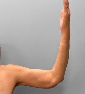 After Image: Abdominoplasty, Lipo, and Arm Lift-Dr.Tucker - left-side
