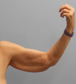 Before Image: Abdominoplasty, Lipo, and Arm Lift-Dr.Tucker - left-side