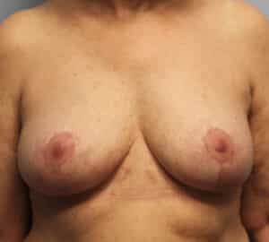 After Image: Breast Implant Removal & Lift- Dr. Howell
