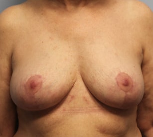 After Image: Breast Implant Removal & Lift- Dr. Howell - front