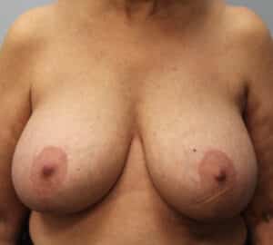 Before Image: Breast Implant Removal & Lift- Dr. Howell