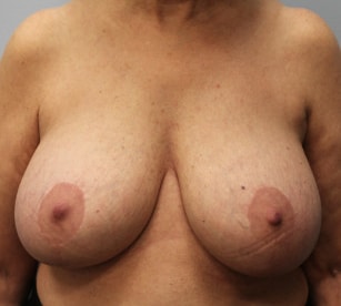 Before Image: Breast Implant Removal & Lift- Dr. Howell - front