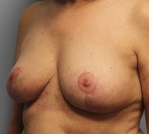 After Image: Breast Implant Removal & Lift- Dr. Howell - left-front-oblique