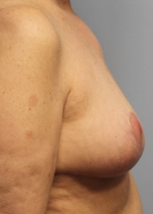 After Image: Breast Implant Removal & Lift- Dr. Howell - right-side