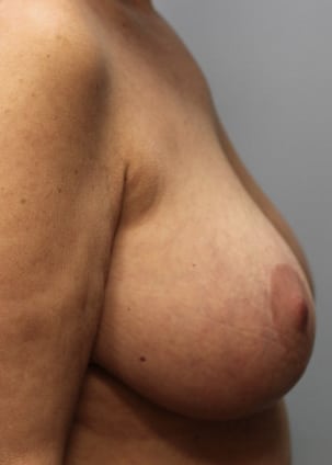 Before Image: Breast Implant Removal & Lift- Dr. Howell - right-side