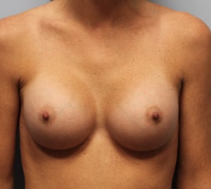 After Image: Breast Augmentation- Dr. Howell - front