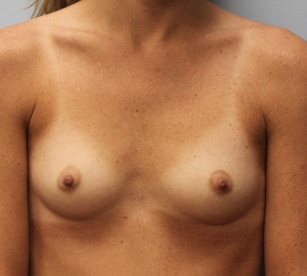 Before Image: Breast Augmentation- Dr. Howell - front