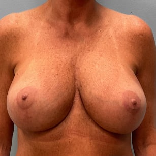 After Image: Breast Augmentation Revision – Dr. Tucker - front
