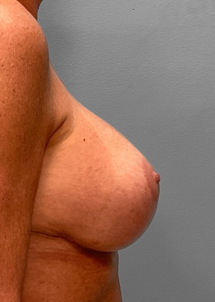 After Image: Breast Augmentation Revision – Dr. Tucker - right-side