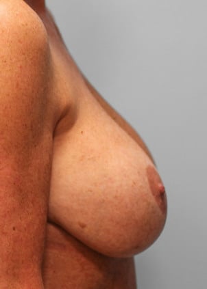 Before Image: Breast Augmentation Revision – Dr. Tucker - right-side