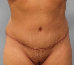 After Image: Abdominoplasty & Lipo – Dr. Tucker - front