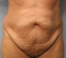 Before Image: Abdominoplasty & Lipo – Dr. Tucker - front