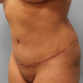 After Image: Abdominoplasty & Lipo – Dr. Tucker - left-front-oblique
